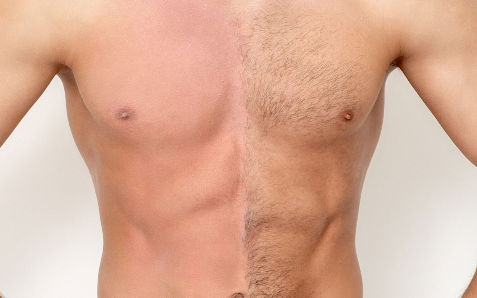 Laser Hair Removal for Men